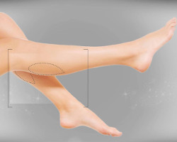 Liposuction of legs in Poltava, Kiev and Kharkov - photo 1