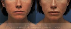 Surgical correction of the shape and volume of the lips (chalinoplasty) image 3884