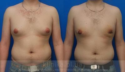 Treatment of gynecomastia before and after operation, photo 7