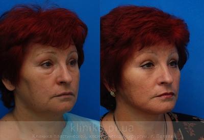Facelifting before and after operation, photo 1