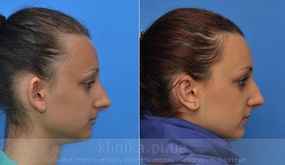 Пластика ушных раковин (отопластика) до и после операции, фото 6