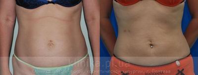 Liposuction before and after operation, photo 8