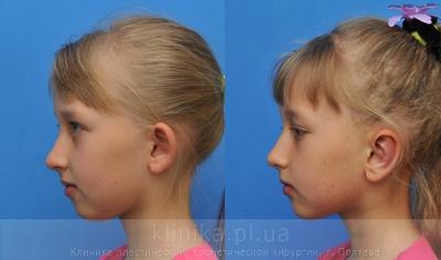 Пластика ушных раковин (отопластика) до и после операции, фото 4