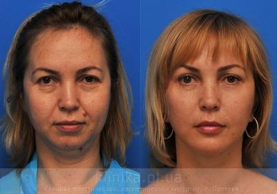 Facelifting before and after operation, photo 5