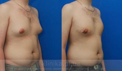 Treatment of gynecomastia before and after operation, photo 8