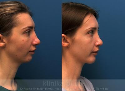Сorrection volume and shape of the chin before and after operation, photo 6