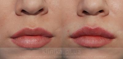 Contour correction before and after operation, photo 5