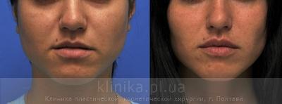 Surgical correction of the shape and volume of the lips (chalinoplasty) before and after operation, photo 3