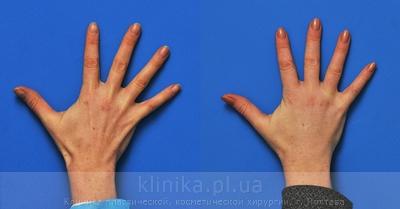 Lipofilling of the hands before and after operation, photo 2