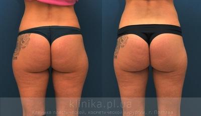Liposuction before and after operation, photo 1