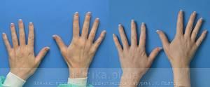 Lipofilling of the hands image 3003