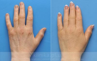 Lipofilling of the hands before and after operation, photo 8