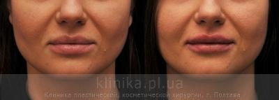 Contour correction before and after operation, photo 3