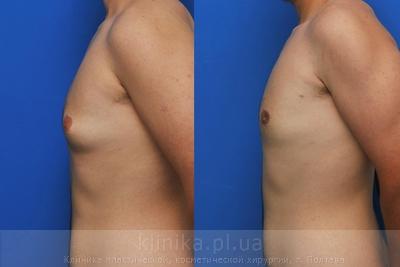 Treatment of gynecomastia before and after operation, photo 6