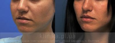 Surgical correction of the shape and volume of the lips (chalinoplasty) before and after operation, photo 4