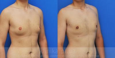Treatment of gynecomastia before and after operation, photo 5