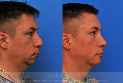 Установка импланта подбородка до и после операции, фото 4