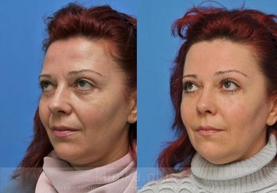 Face lipofilling before and after operation, photo 1