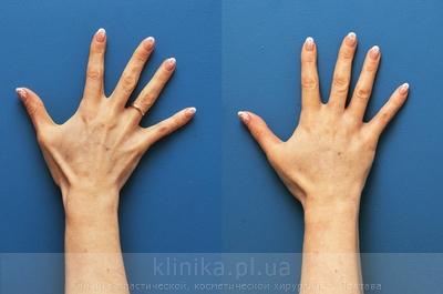 Lipofilling of the hands before and after operation, photo 7