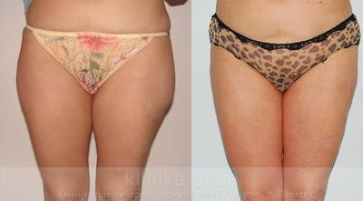 Liposuction before and after operation, photo 6