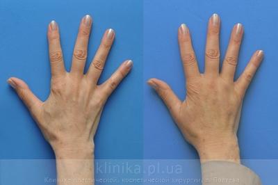 Lipofilling of the hands before and after operation, photo 4