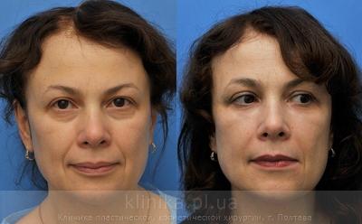 Face lipofilling before and after operation, photo 3