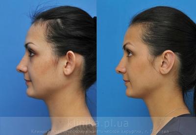Пластика ушных раковин (отопластика) до и после операции, фото 8