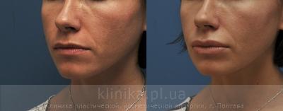 Surgical correction of the shape and volume of the lips (chalinoplasty) before and after operation, photo 2