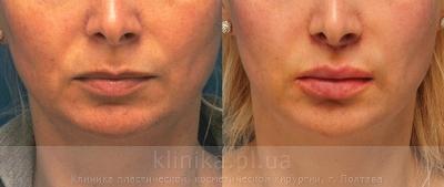 Surgical correction of the shape and volume of the lips (chalinoplasty) before and after operation, photo 9