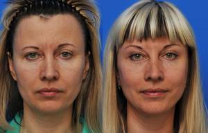 Forehead plastic surgery (frontoplasty)