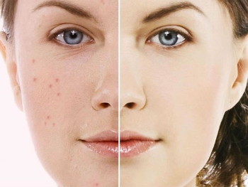 How is it possible to get rid of traces after acne?
