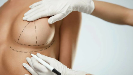 Складка під грудьми після маммопластики: причини і методи корекції