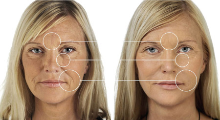 Blepharoplasty or lipofilling - what to choose