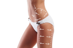 Liposuction of hips and buttocks in Poltava, Kiev and Kharkov - photo 1