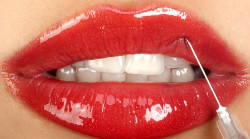 Ущільнення після ін'єкційного збільшення губ - в чому небезпека і як їх позбутися фото 2