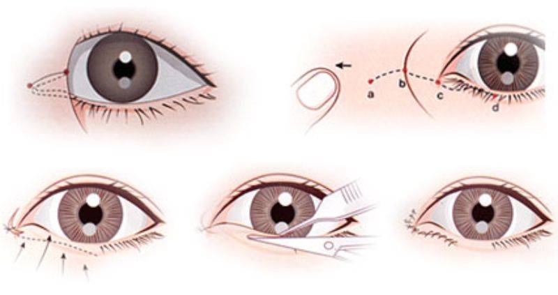 Кантопластика ᐉ Цена хирургического увеличения глаз в Полтаве • Отзывы о  кантопластике пациентов из Киева и Харькова