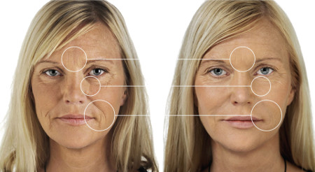 Contour plasty: lipofilling or fillers?