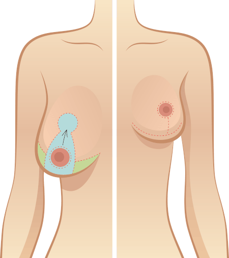 Features of breast augmentation during mammary gland involution