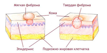 Removal of fibroids in Poltava, Kiev and Kharkov - photo 2