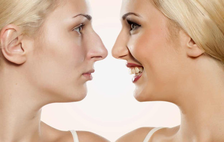 Implants for rhinoplasty: types, pros and cons