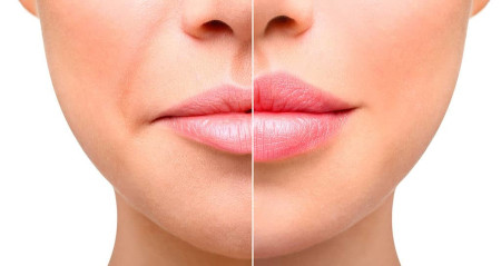 Lip augmentation - TOP 10 common patient errors