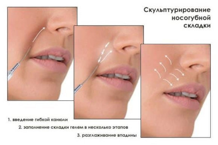 Correction of nasolabial folds in Poltava, Kiev and Kharkov - photo 1