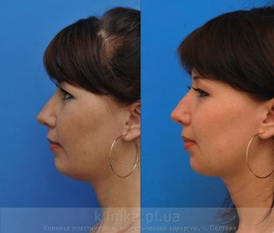 Сorrection volume and shape of the chin before and after operation, photo 8