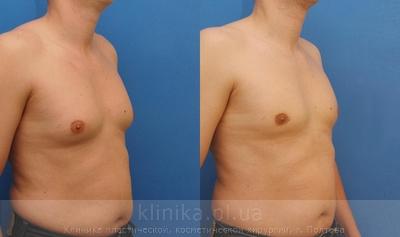 Treatment of gynecomastia before and after operation, photo 2
