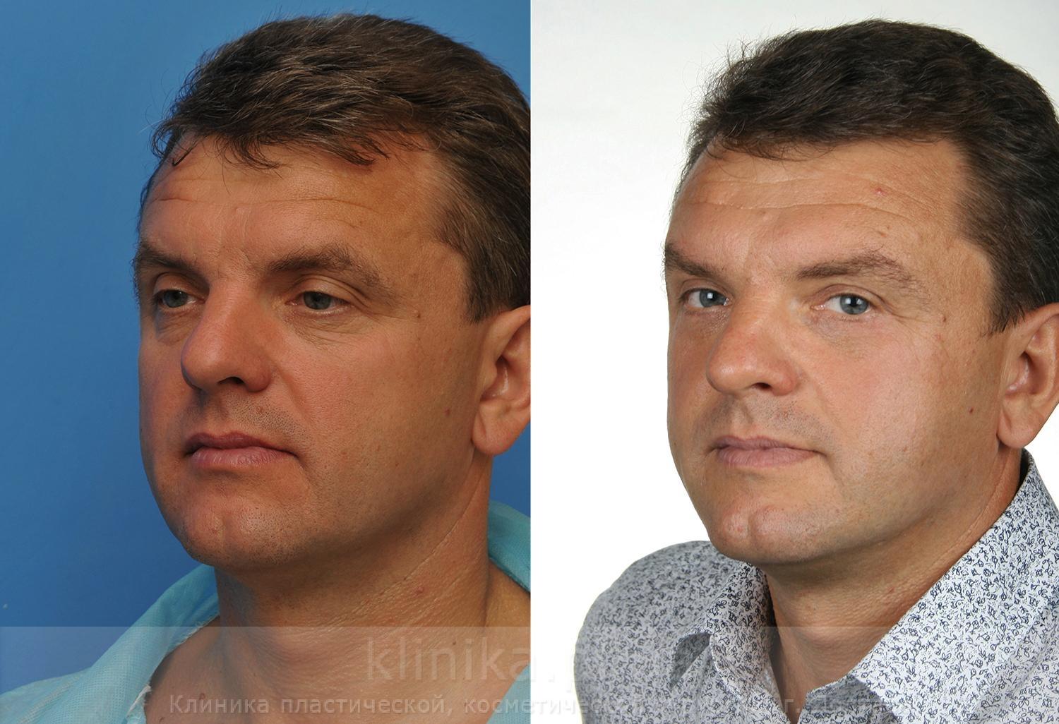 мужская пластика фото до и после