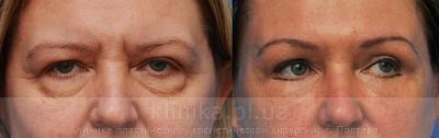 Blepharoplasty before and after operation, photo 6