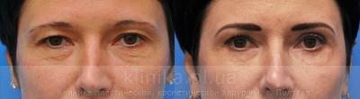 Blepharoplasty before and after operation, photo 2