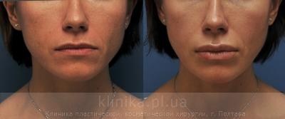 Surgical correction of the shape and volume of the lips (chalinoplasty) before and after operation, photo 1