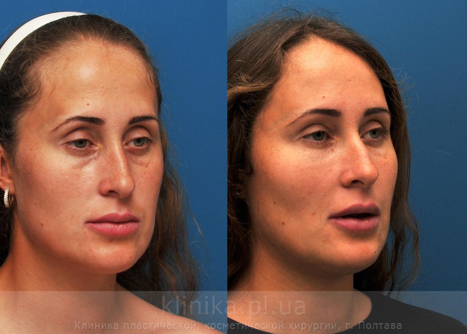 Galeria foto de ridicare a feței și gâtului, doctor Yohann Derhy