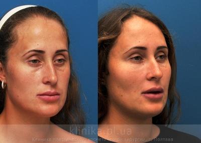 Face lipofilling before and after operation, photo 8